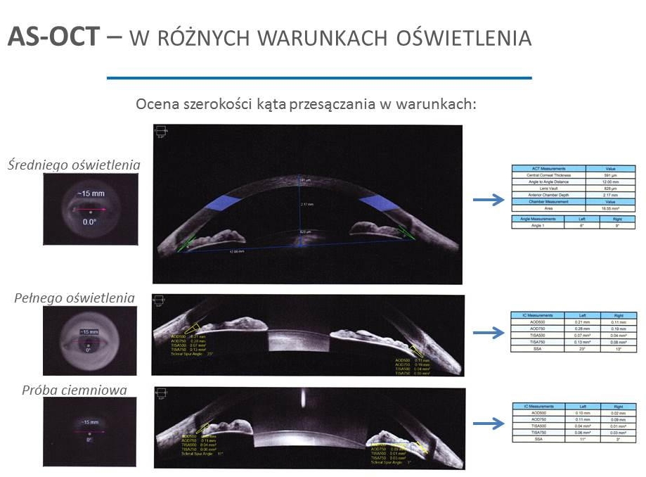 Jaskra z zamkniętym kątem przesączania