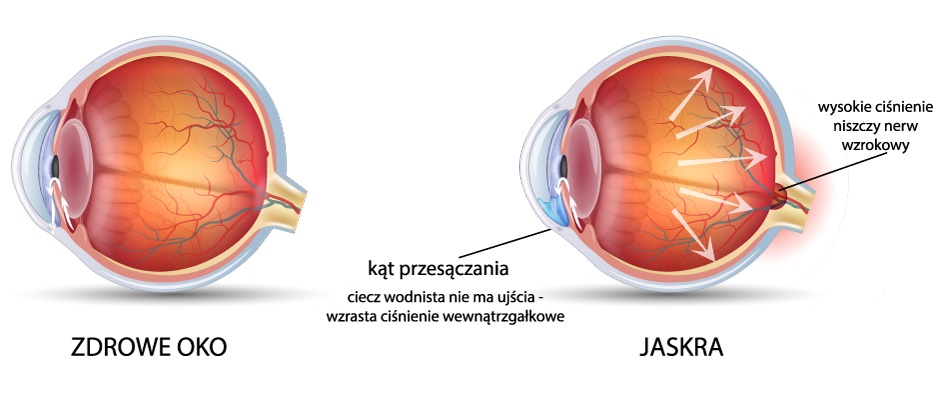 Irydotomia laserowa YAG