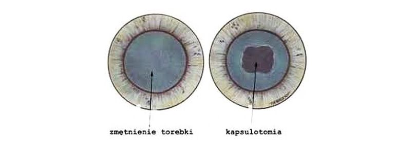 Kapsulotomia laserowa YAG