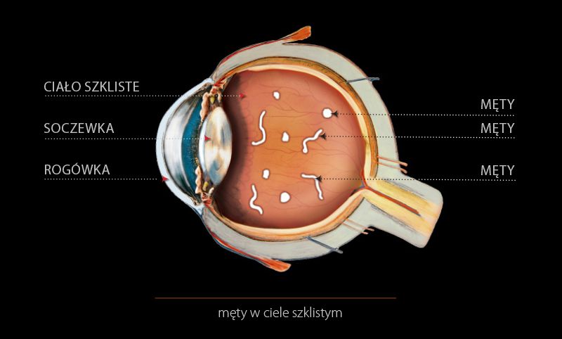 choroby-oczu10
